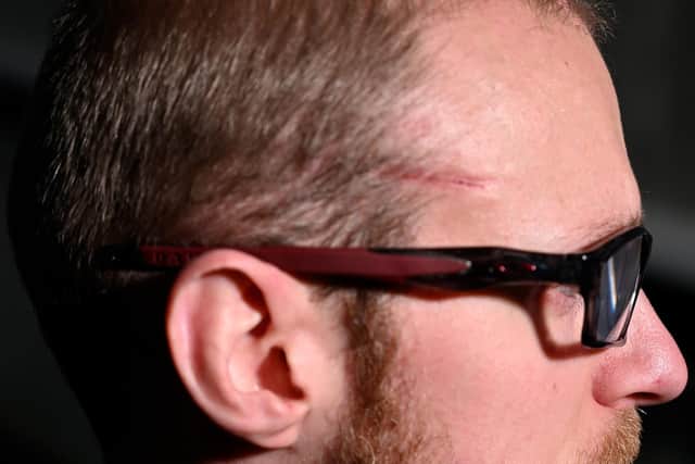 PS Cayton still carries a scar on his temple after being shot with ball bearings