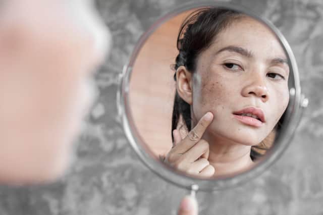 if your skin is struggling due to face coverings and wearing one is causing flare ups of acne or an influx of new spots, don’t despair (Photo: Doucefleur/Shutterstock)